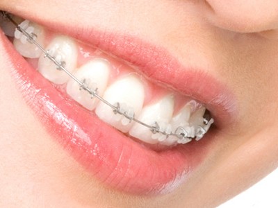 Керамические брекеты: особенности и преимущества