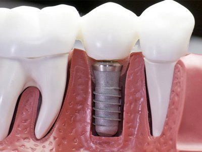 Установка коронок на зубы: особенности, причины и этапы установки