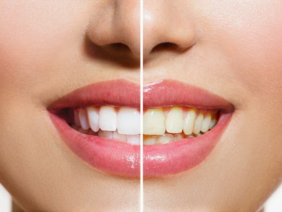 Эффективное отбеливание зубов стоматологами и самостоятельно