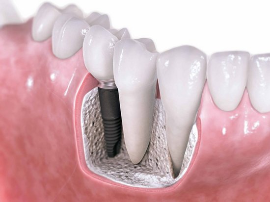 Ортопедическая стоматология: особенности протезирования