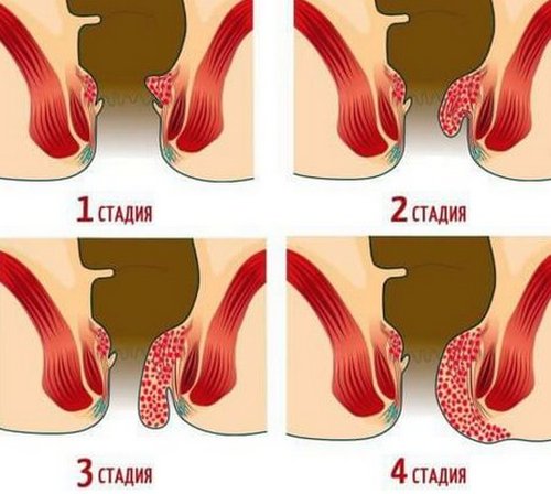 стадии геммороя