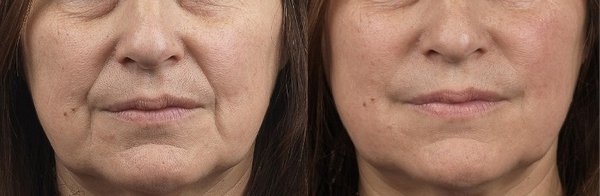 Филлеры в носогубные складки до и после