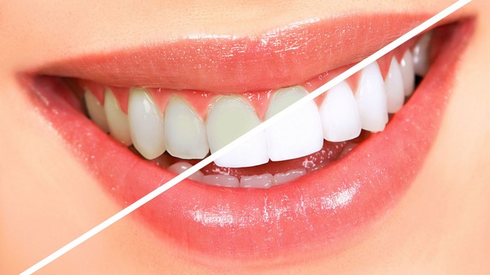 Внутриканальное отбеливание зубов: все о преимуществах и недостатках процедуры