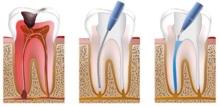 Внутриканальное отбеливание зубов