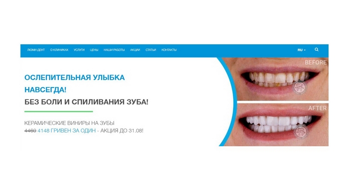Виниры на зубы Киев стоматология Люми-Дент