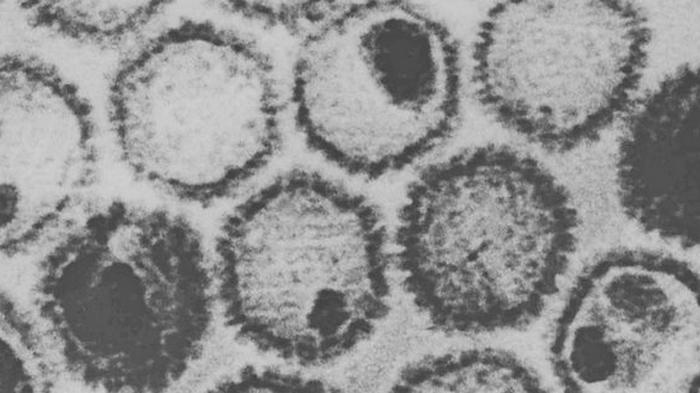 Организм впервые на 90% очистили от вируса герпеса: создан новый метод терапии