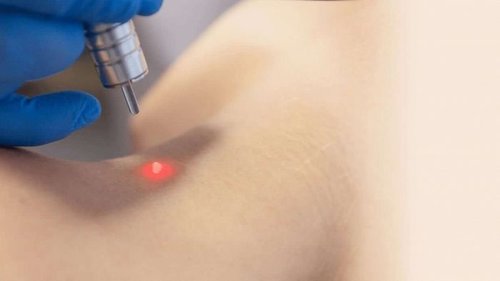 Лазерное удаление папиллом: особенности процесса