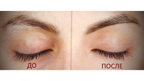 Кому можно записаться на лазерную эпиляцию бровей и в чем особенности