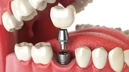 Имплантация зубов