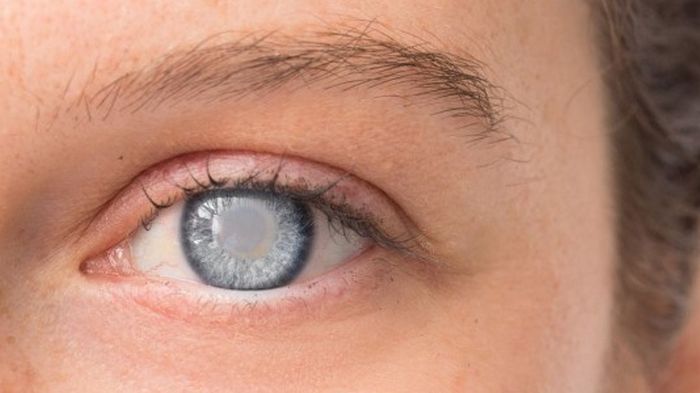 Что необходимо знать о глаукоме?