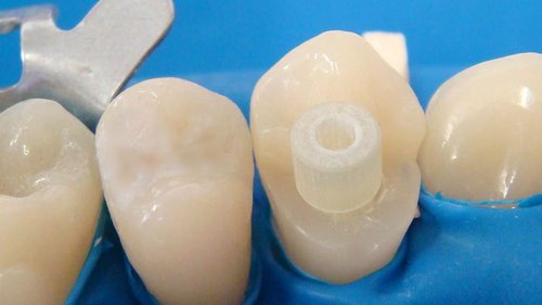 Стекловолоконный штифт