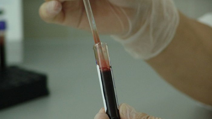 В Индии у больного коронавирусом извлекли длинный кровяной тромб (фото)