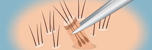 Ручная техника пересадки волос методом FUE