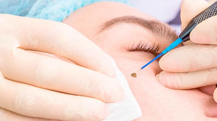 Профессиональное удаление родинок в Лазерхауз