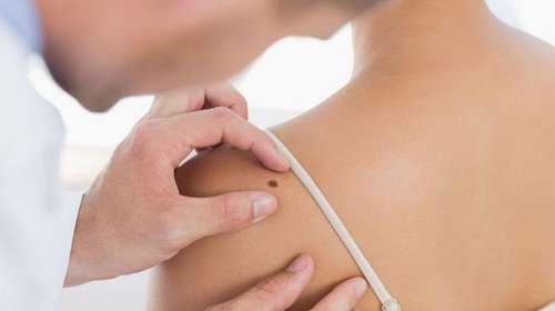 Профессиональное удаление родинок в Лазерхауз