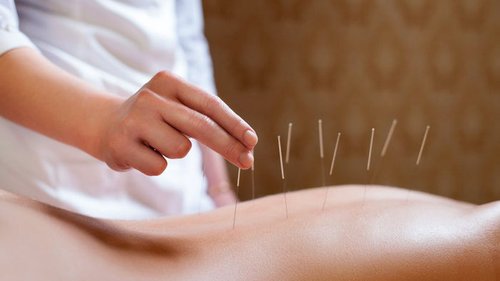 иглоукалывание при остеохондрозе