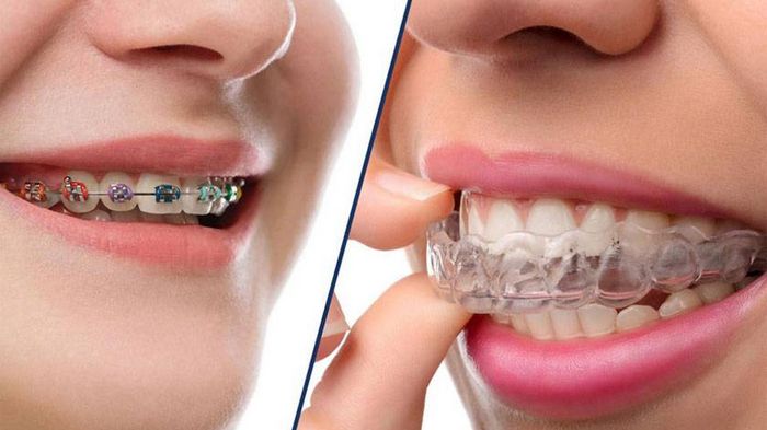 Кому нужны брекеты и в чем их преимущества