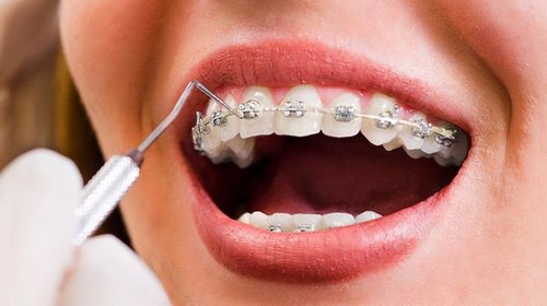 Кому нужны брекеты и в чем их преимущества