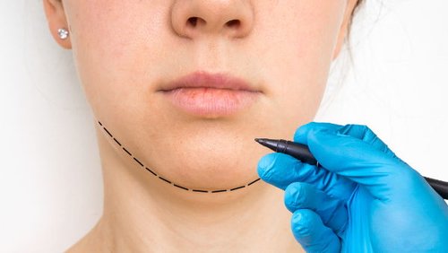 ментопластика