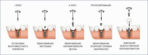установка зубных имплантов