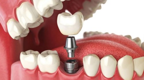 Что необходимо знать об имплантации зубов?