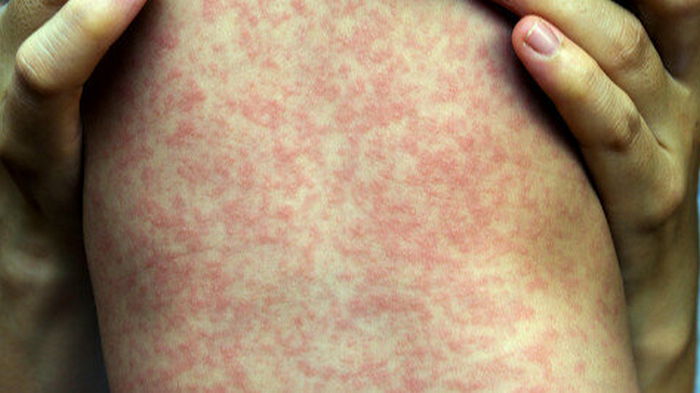 В Афганистане эпидемия кори: США приостановили эвакуацию