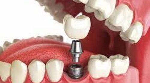 Причины популярности зубных имплантов