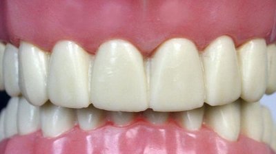 Глибокий прикус зубів: ознаки та лікування