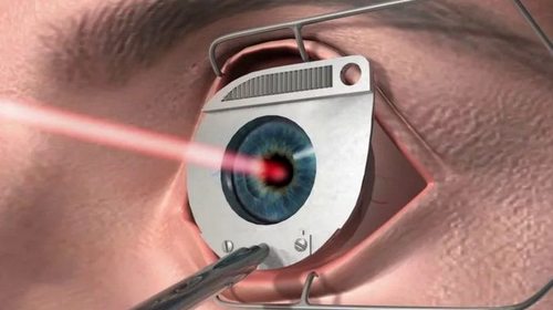 Центр лазерной коррекции зрения «Тарус»: услуги и преимущества