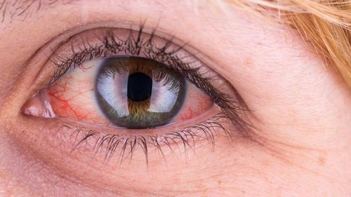 Лечение гемофтальма: как лечат заболевание и как оно проявляется?