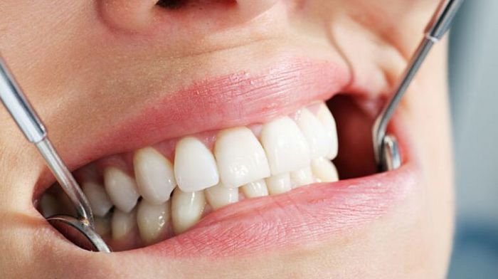 Особенности несъемного протезирования зубов