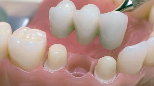 Особенности несъемного протезирования зубов