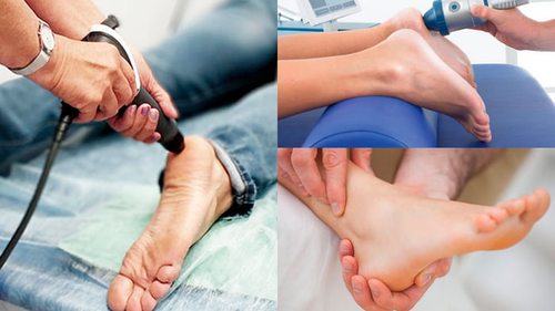 лечение подошвенного фасциита