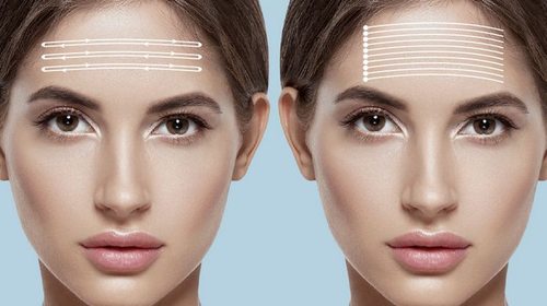 Нитевой лифтинг APTOS дарит красоту и молодость