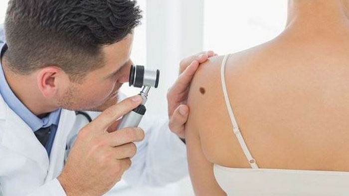 Врач рассказал, как отличить родинку от меланомы