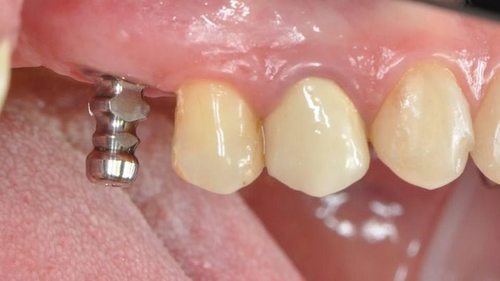 Синус лифтинг: виды и особенности операции