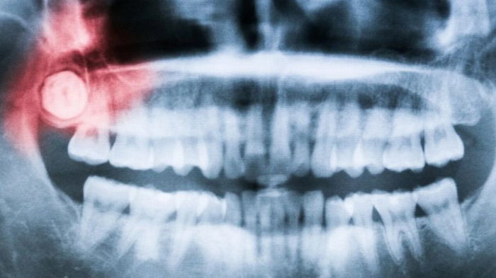 Ученые выяснили, почему у людей растут зубы мудрости во взрослом возрасте