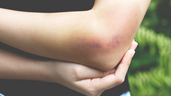 8 народных методов от синяков