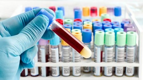 Анализ крови на билирубин: особенности проведения
