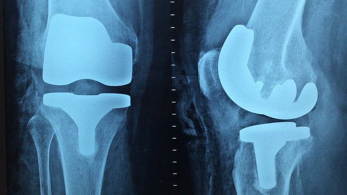 Что такое протезирование коленного сустава?