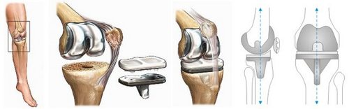 протезирование коленного сустава