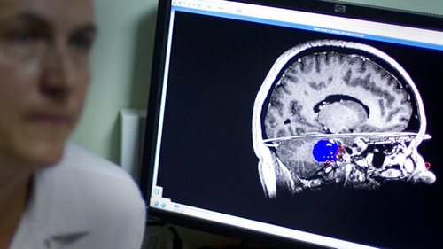 глиобластома