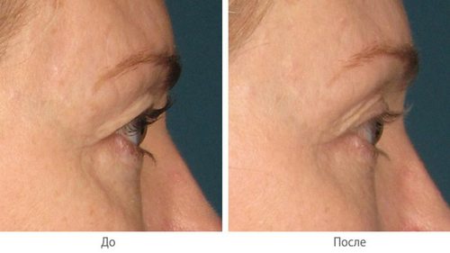 Как влияет альтера-терапия области вокруг глаз на состояние кожи
