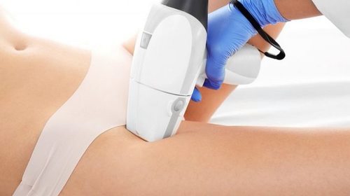 Удаление волос в зоне бикини: достоинства лазерной эпиляции