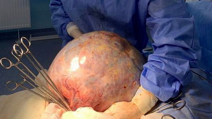 В Кропивницком онкологи удалили опухоль весом в 10 кг