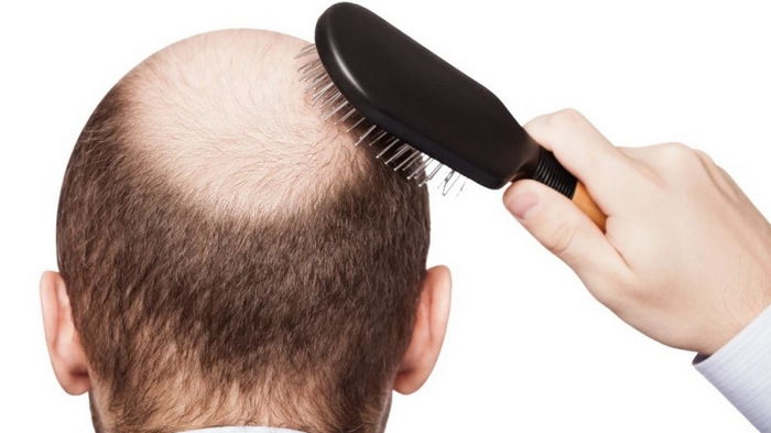 Мужское облысение: медики рассказали, какие существуют методы борьбы с потерей волос