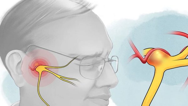 воспаление тройничного нерва