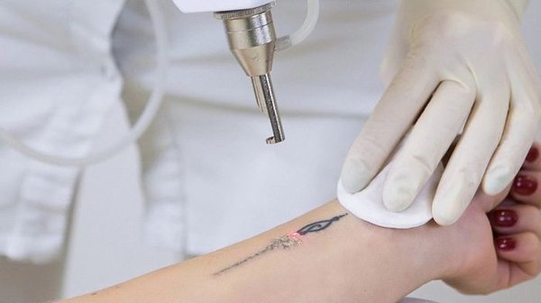 Как правильно выбирать аппараты для удаления тату и что учитывать