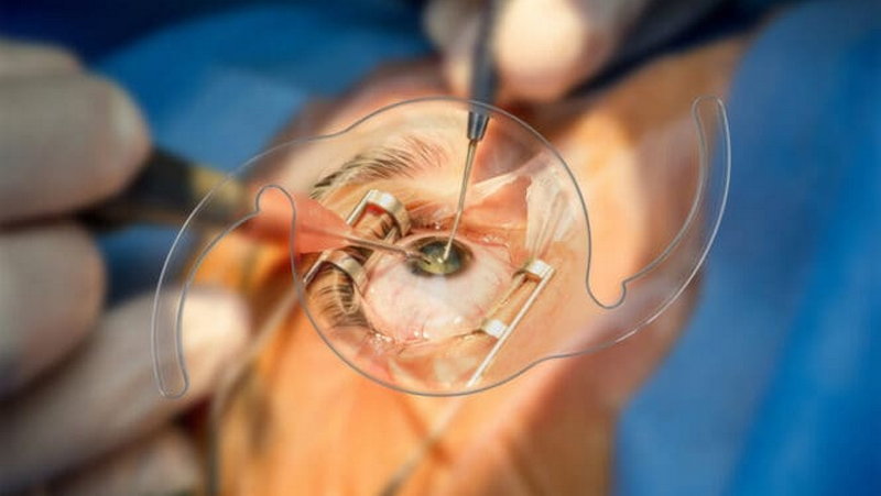 Как проходит операция по замене хрусталика глаза