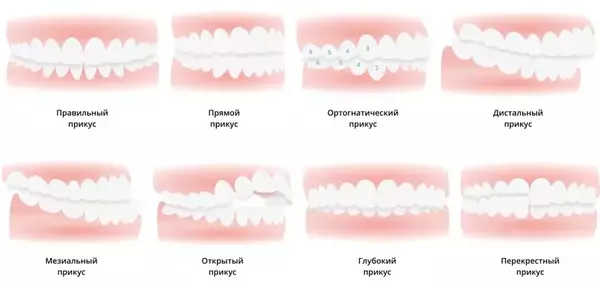 Виды неправильного прикуса